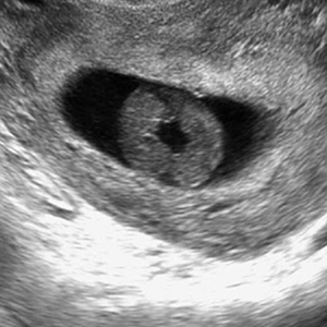 early twin pregnancy